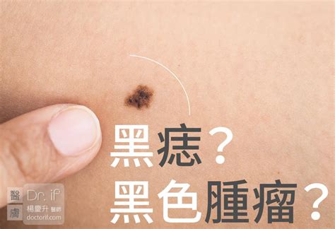 陰囊痣|陰囊上的痣：是否需要切片檢查和去除？